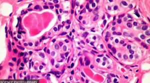 Image de cellules cancéreuses