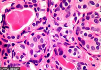 Image de cellules cancéreuses