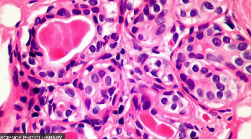 Image de cellules cancéreuses